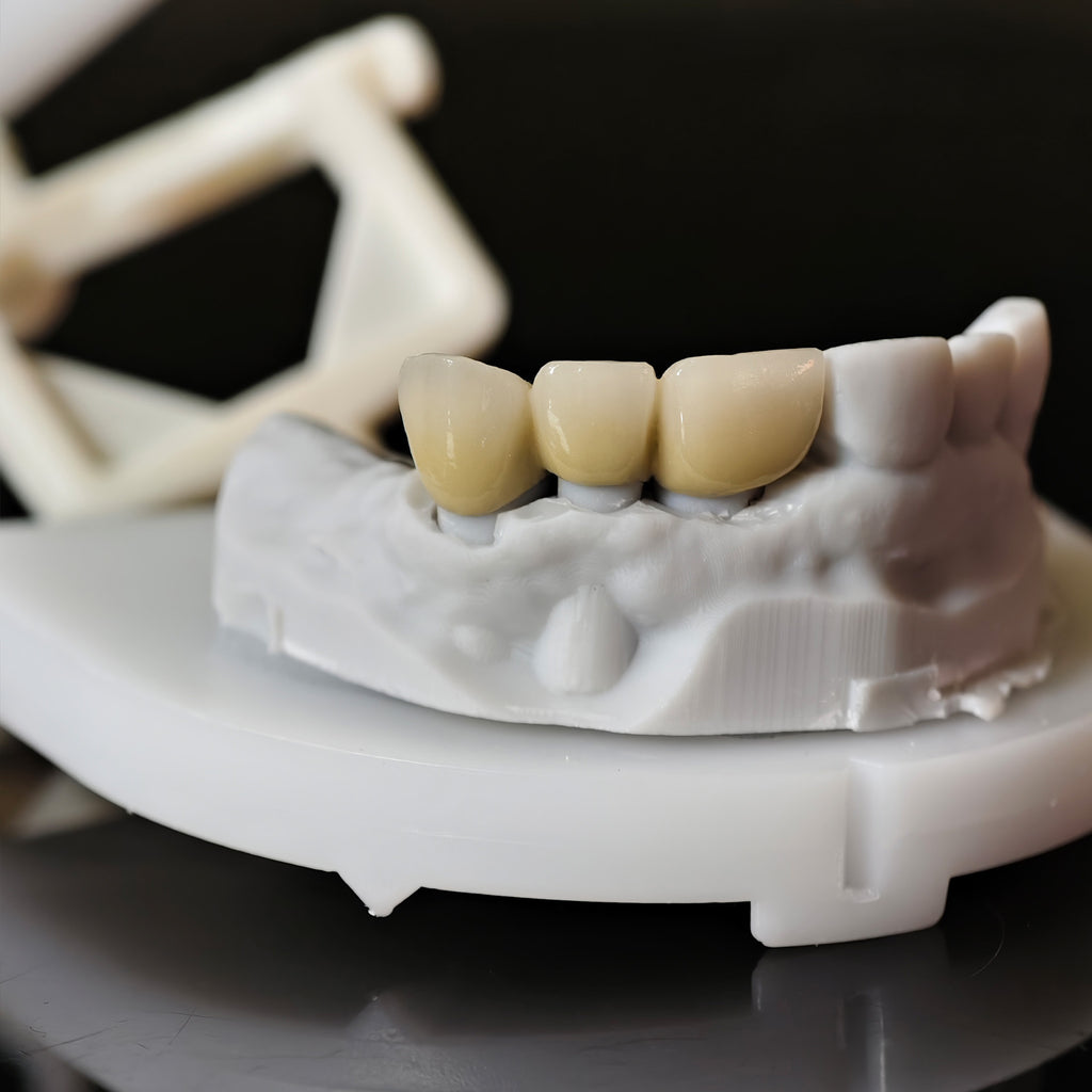 Co - Cr PFM Dental Bridge With Metal Post-And-Core