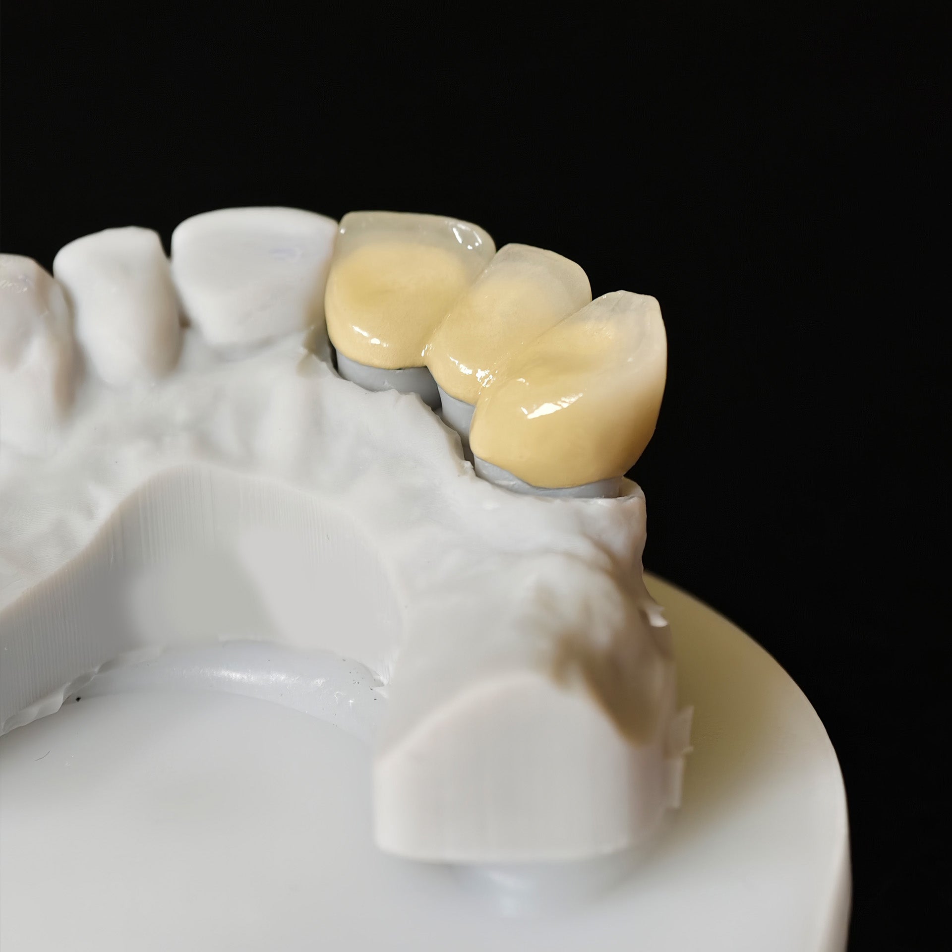 Co - Cr PFM Dental Bridge With Metal Post-And-Core