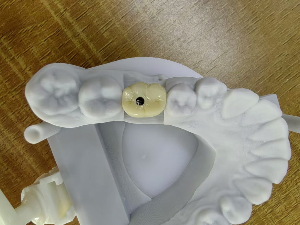 Zirconia Implant Crown Screw Retained Zirconia Dental Crown