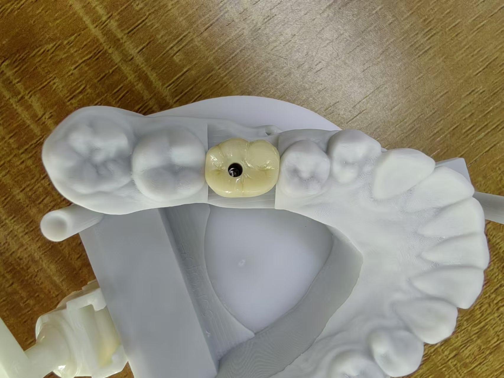 Zirconia Implant Crown Screw Retained Zirconia Dental Crown