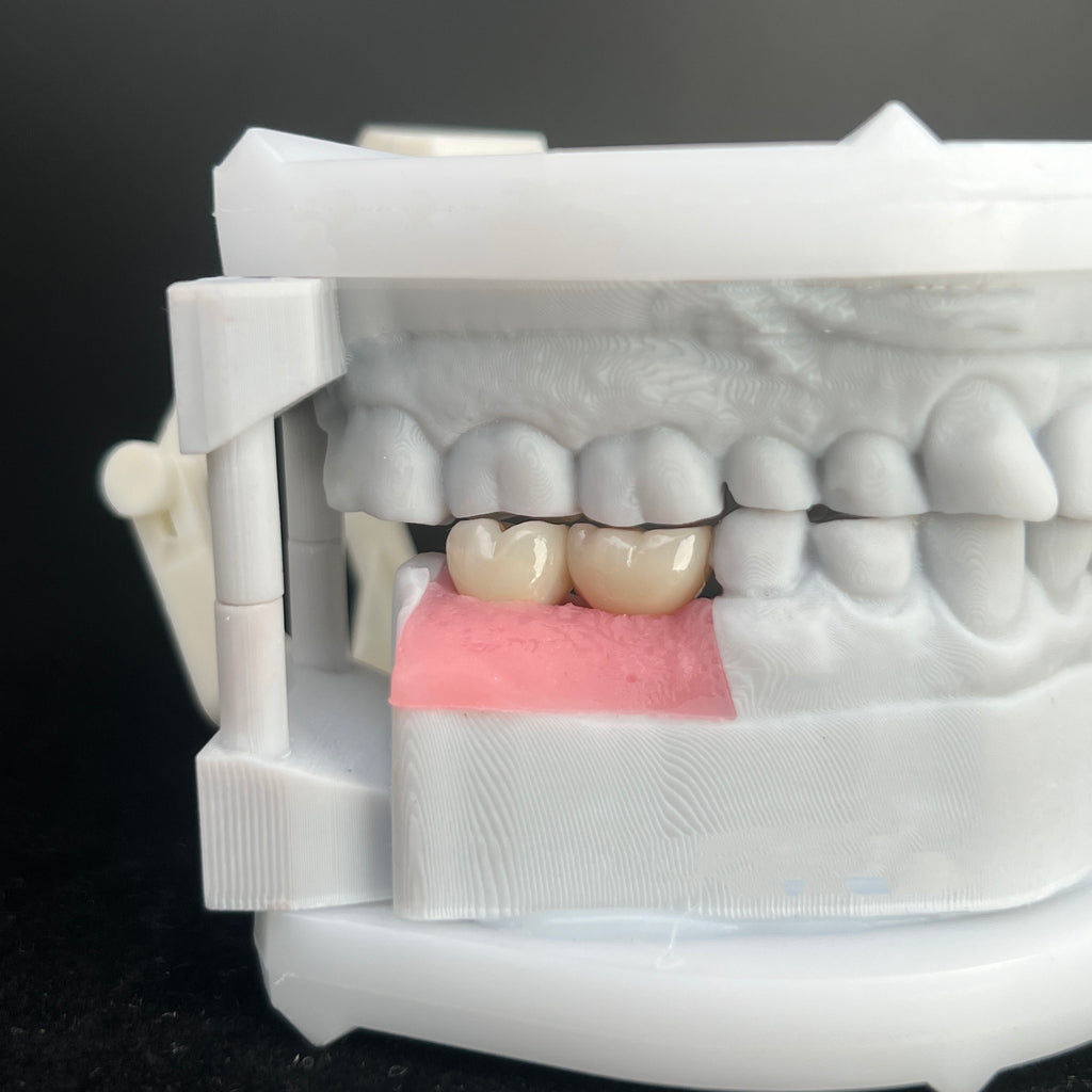 Ultra - Thin Zirconia Implant Bridge