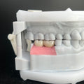 Ultra - Thin Zirconia Implant Bridge