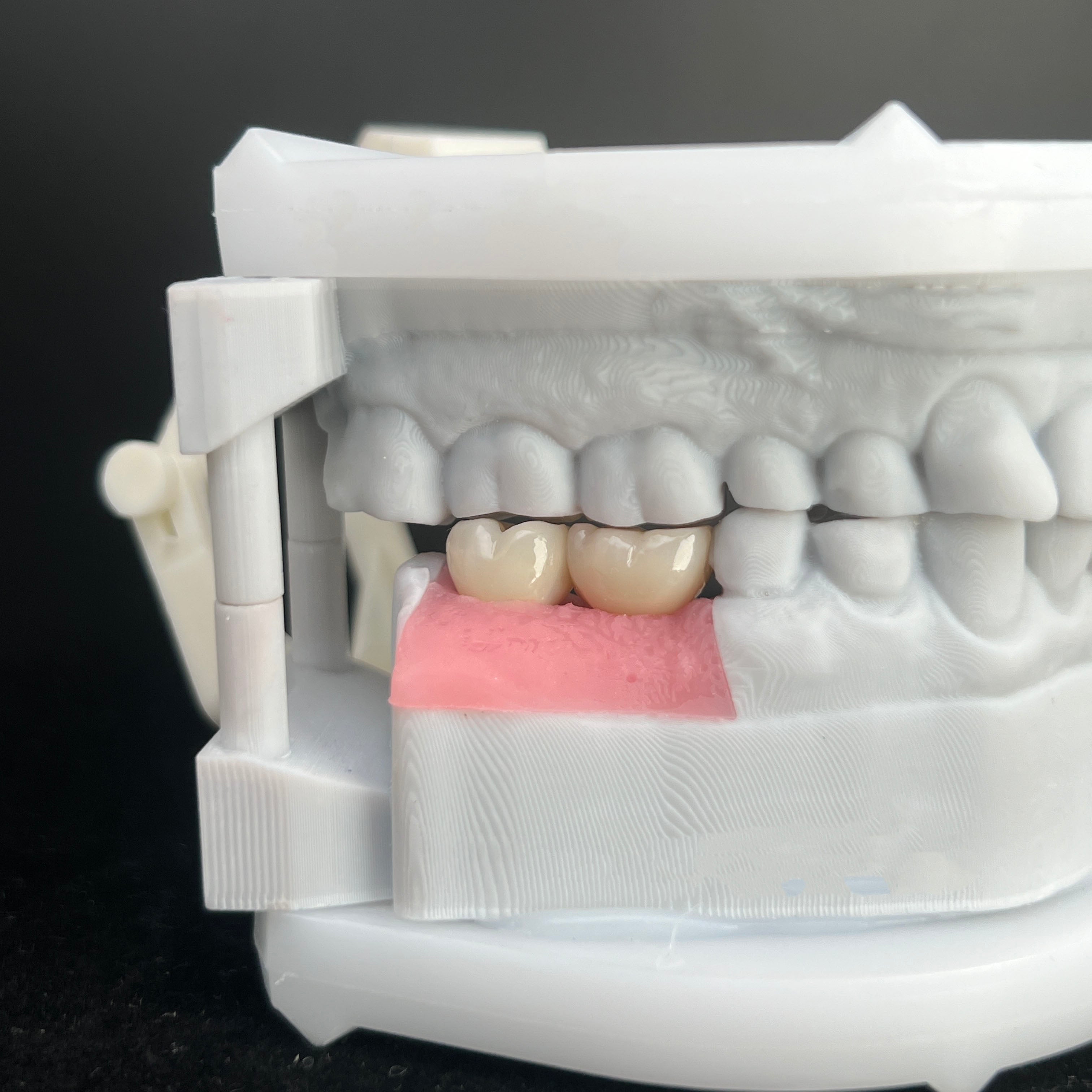 Ultra - Thin Zirconia Implant Bridge