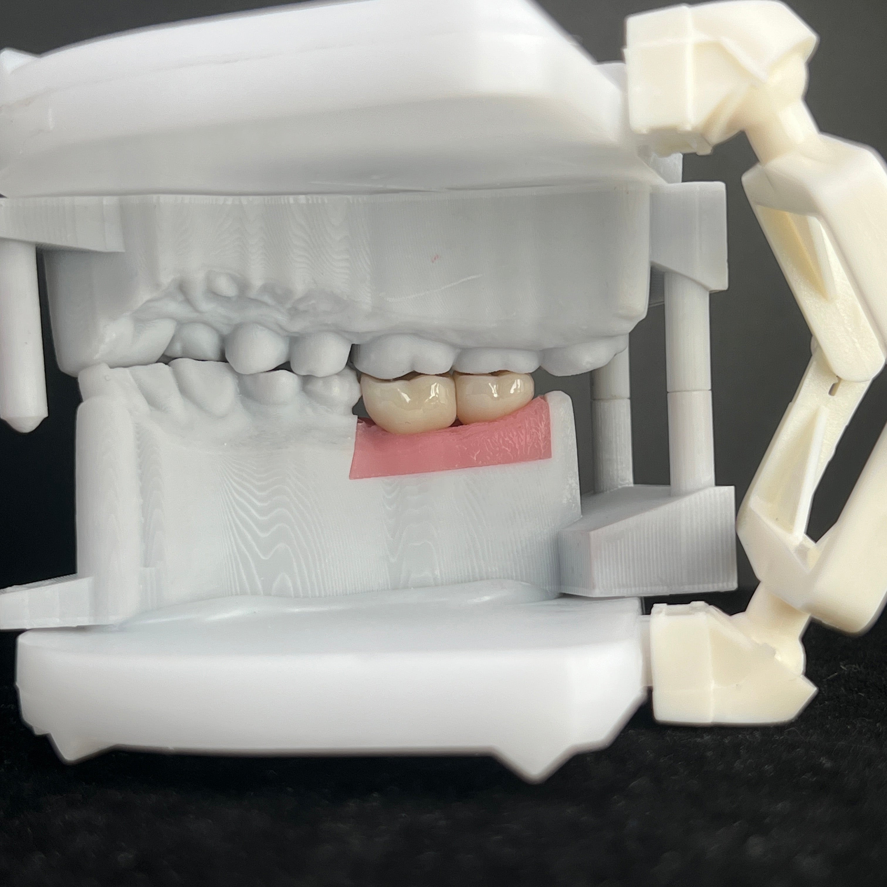 Ultra - Thin Zirconia Implant Bridge