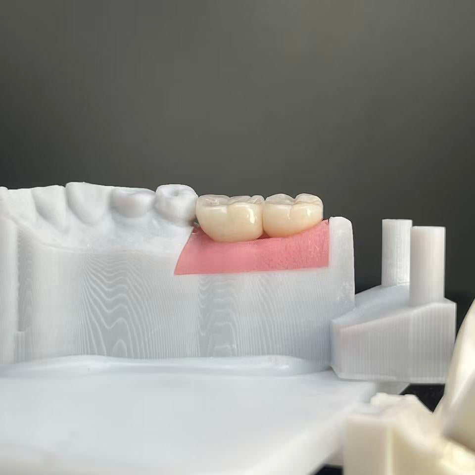 Ultra - Thin Zirconia Implant Bridge