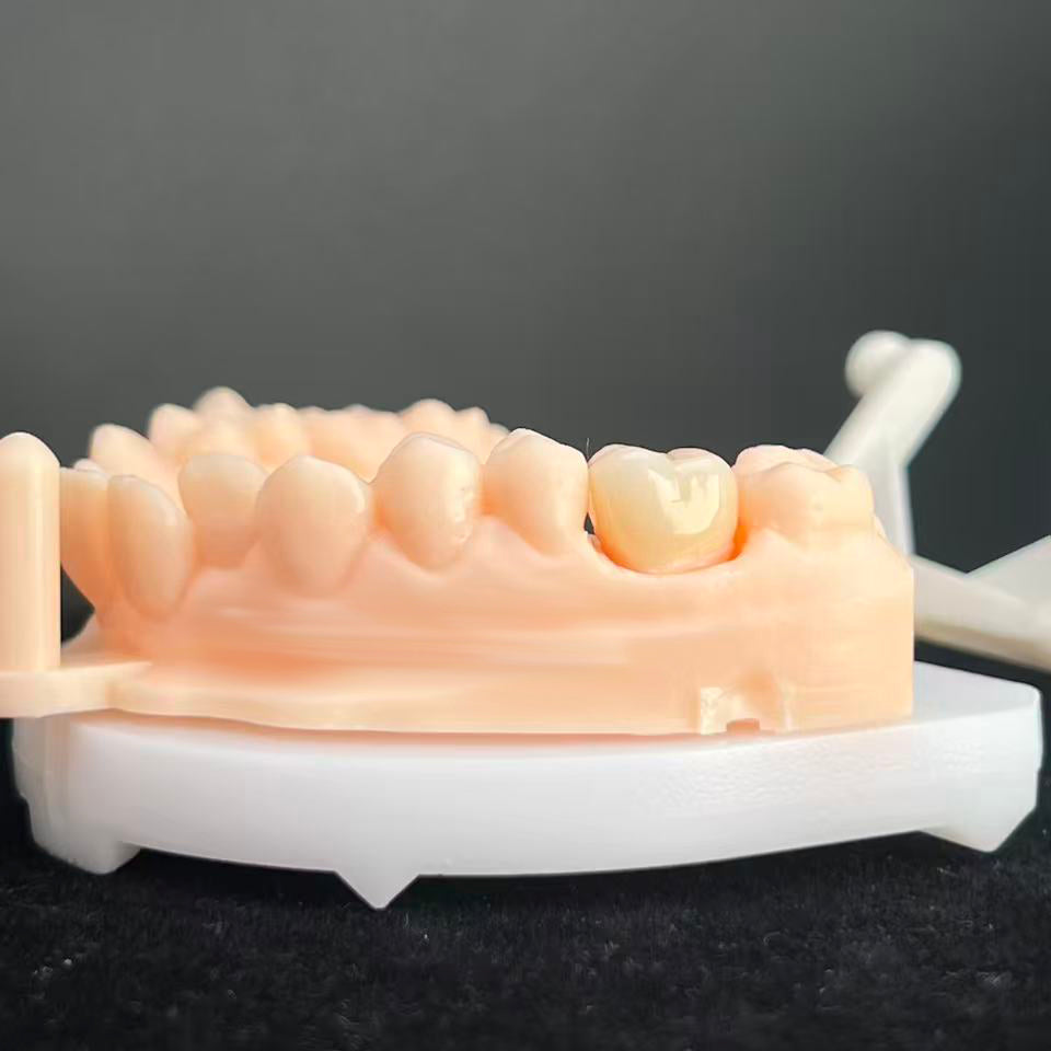 Natural - Looking Zirconia Crowns