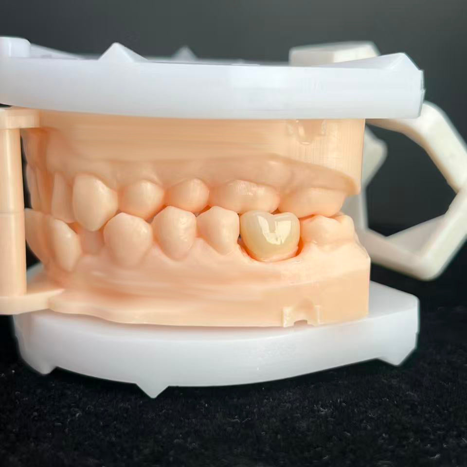 Natural - Looking Zirconia Crowns