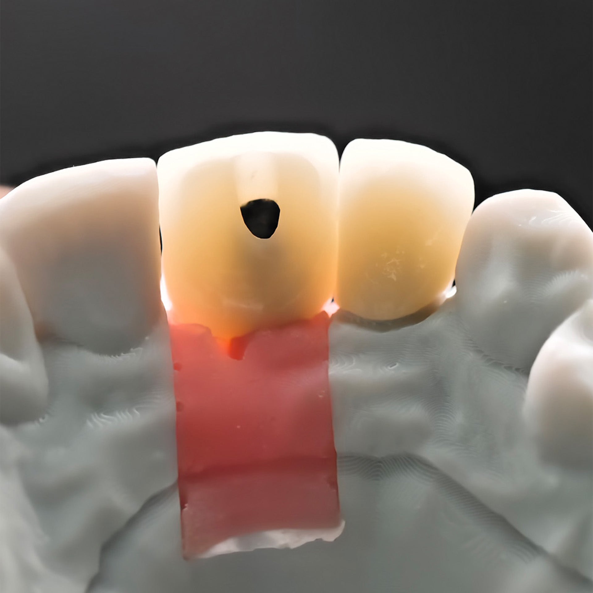 Ustom Zirconia Implant Crowns
