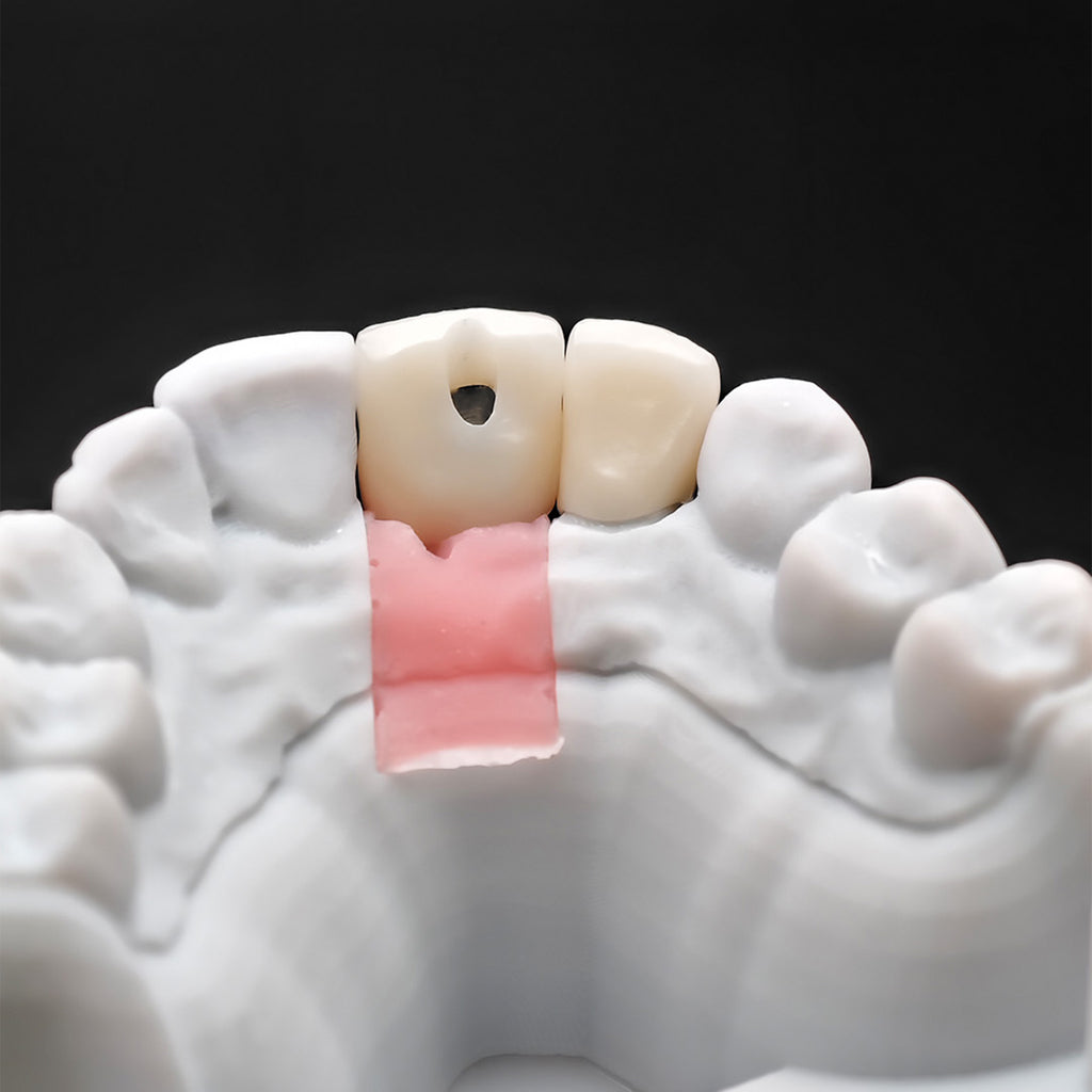 Ustom Zirconia Implant Crowns