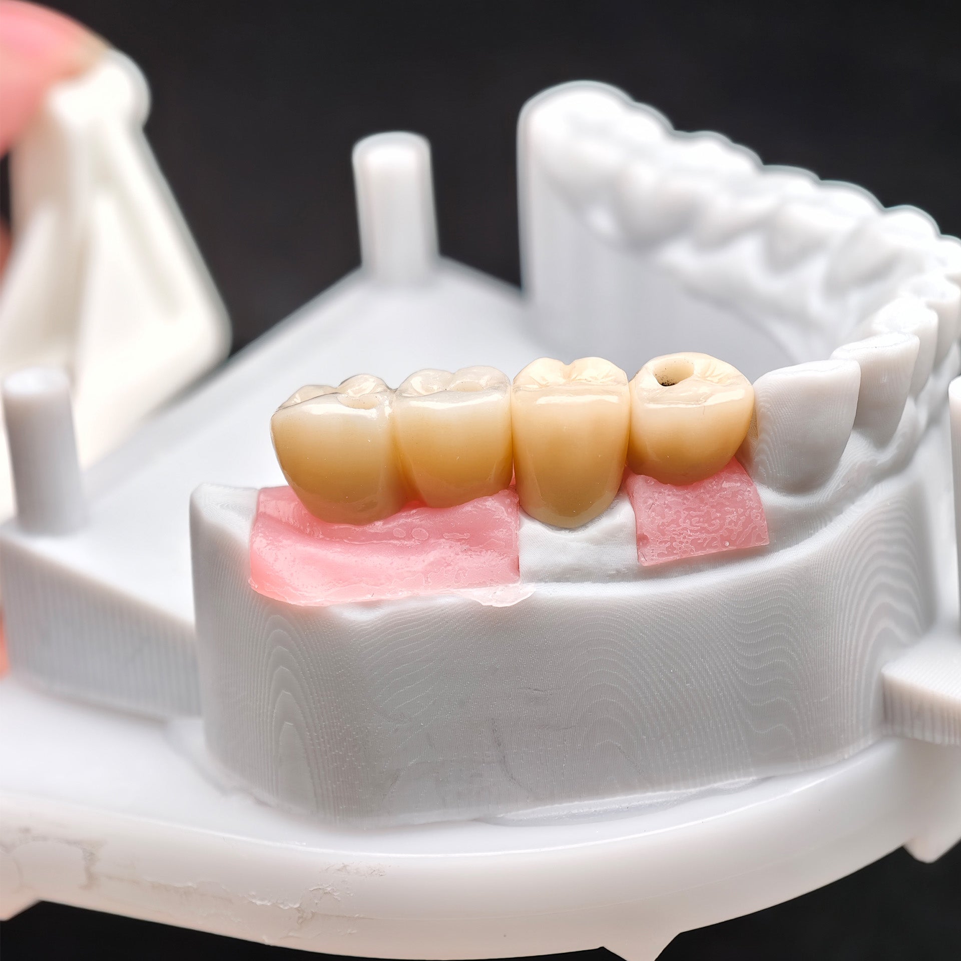 Custom Zirconia Implant Crown And Bridge