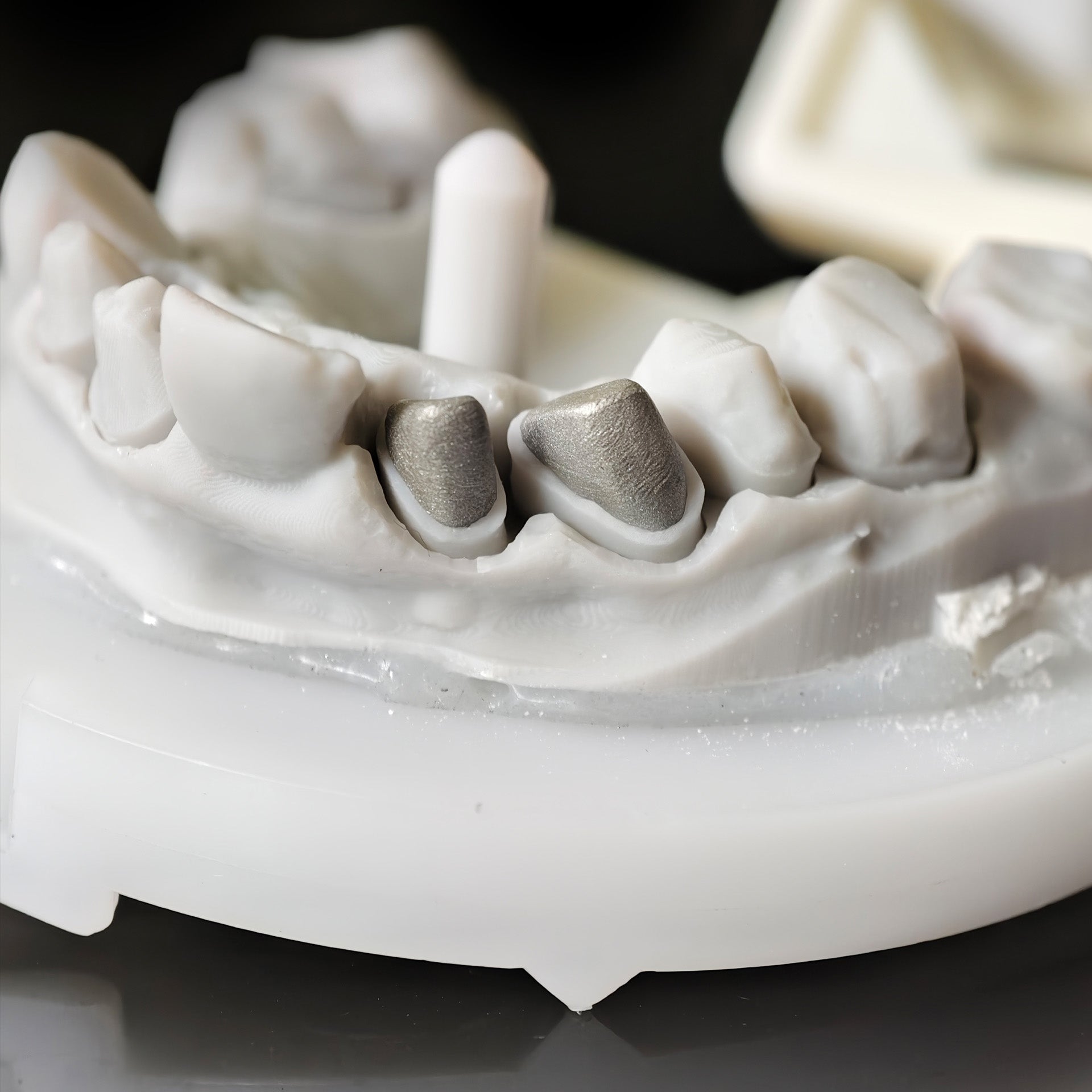 Co - Cr PFM Dental Bridge With Metal Post-And-Core
