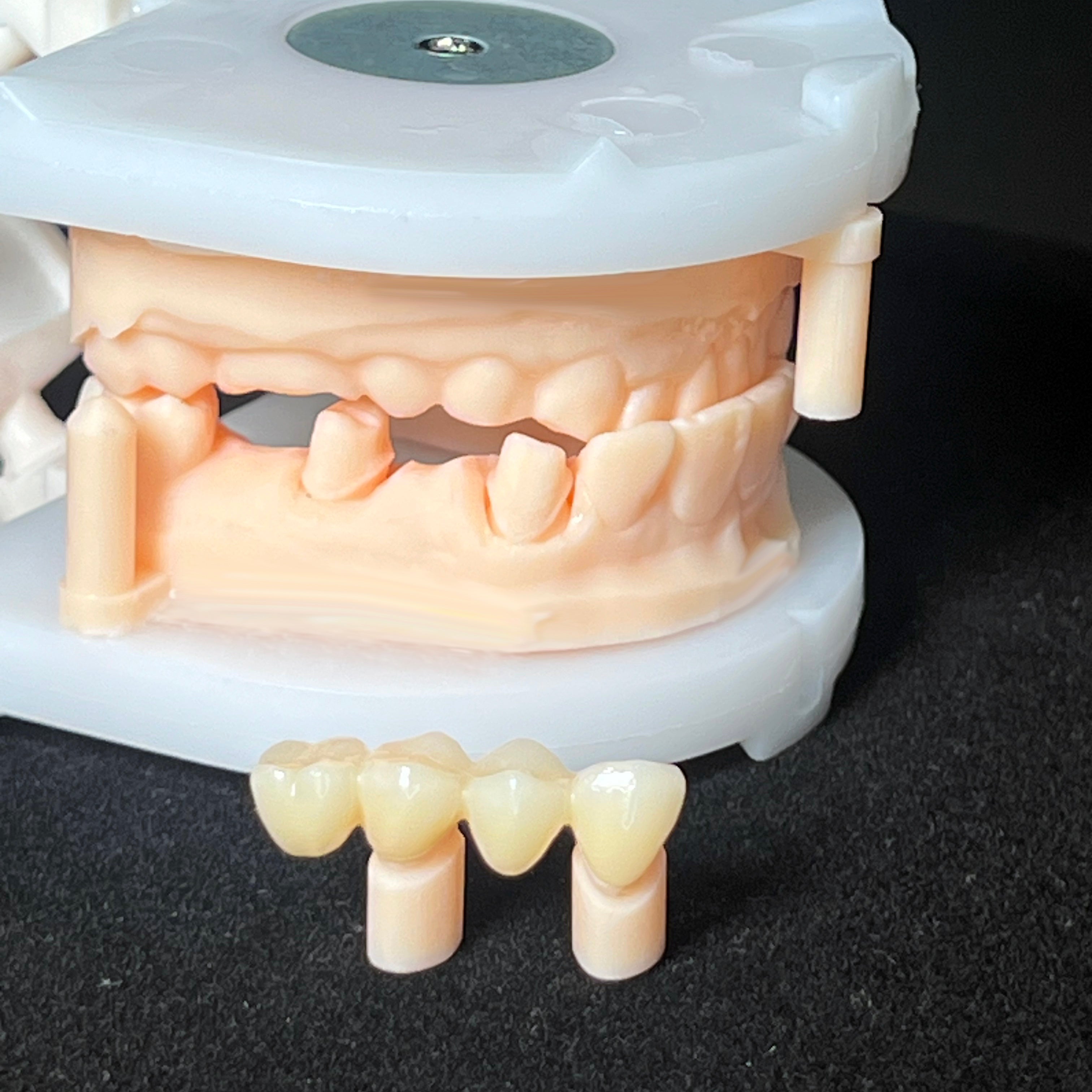 Multilayer Zirconia Crowns & Bridges