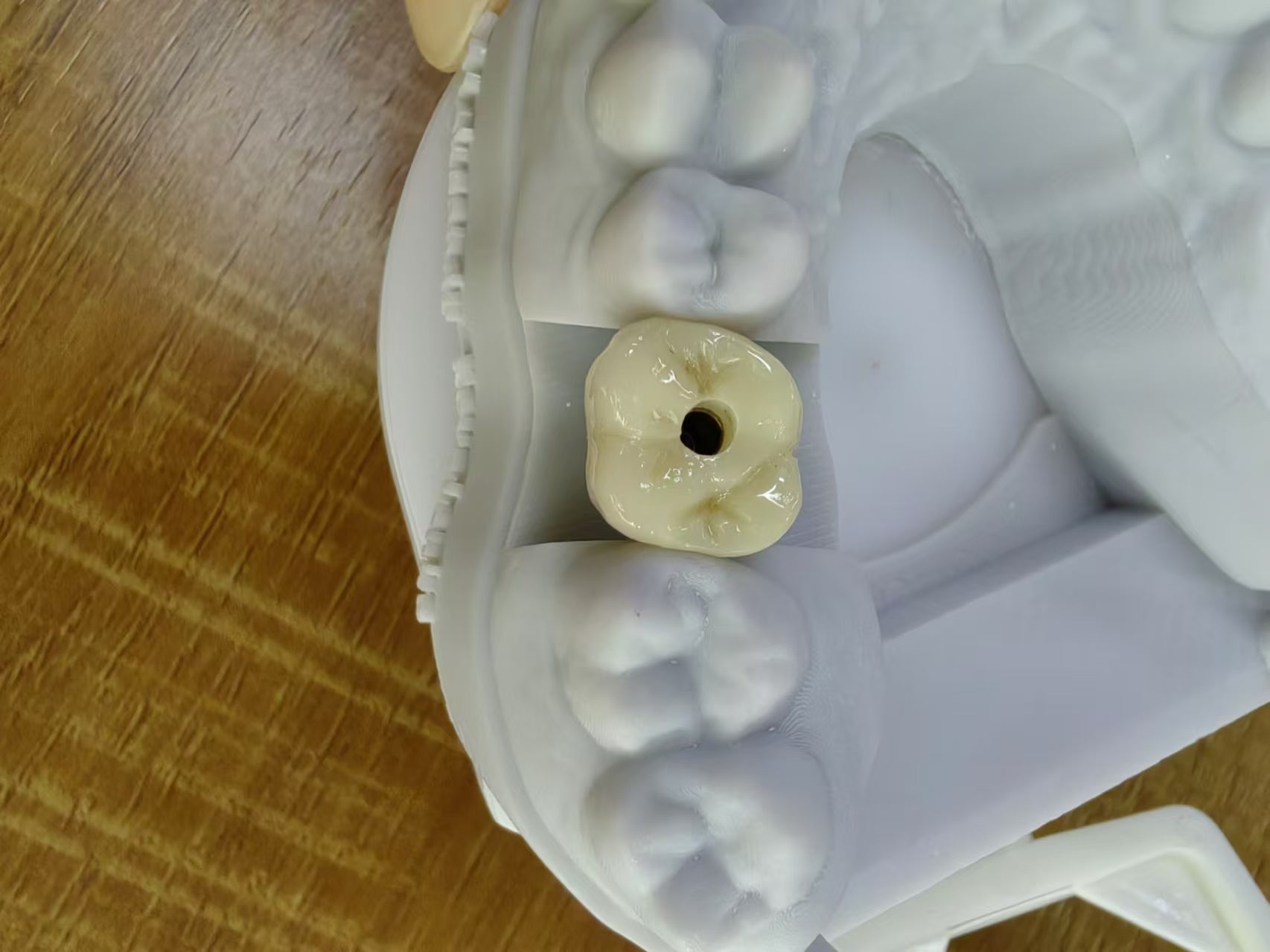Zirconia Implant Crown Screw Retained Zirconia Dental Crown