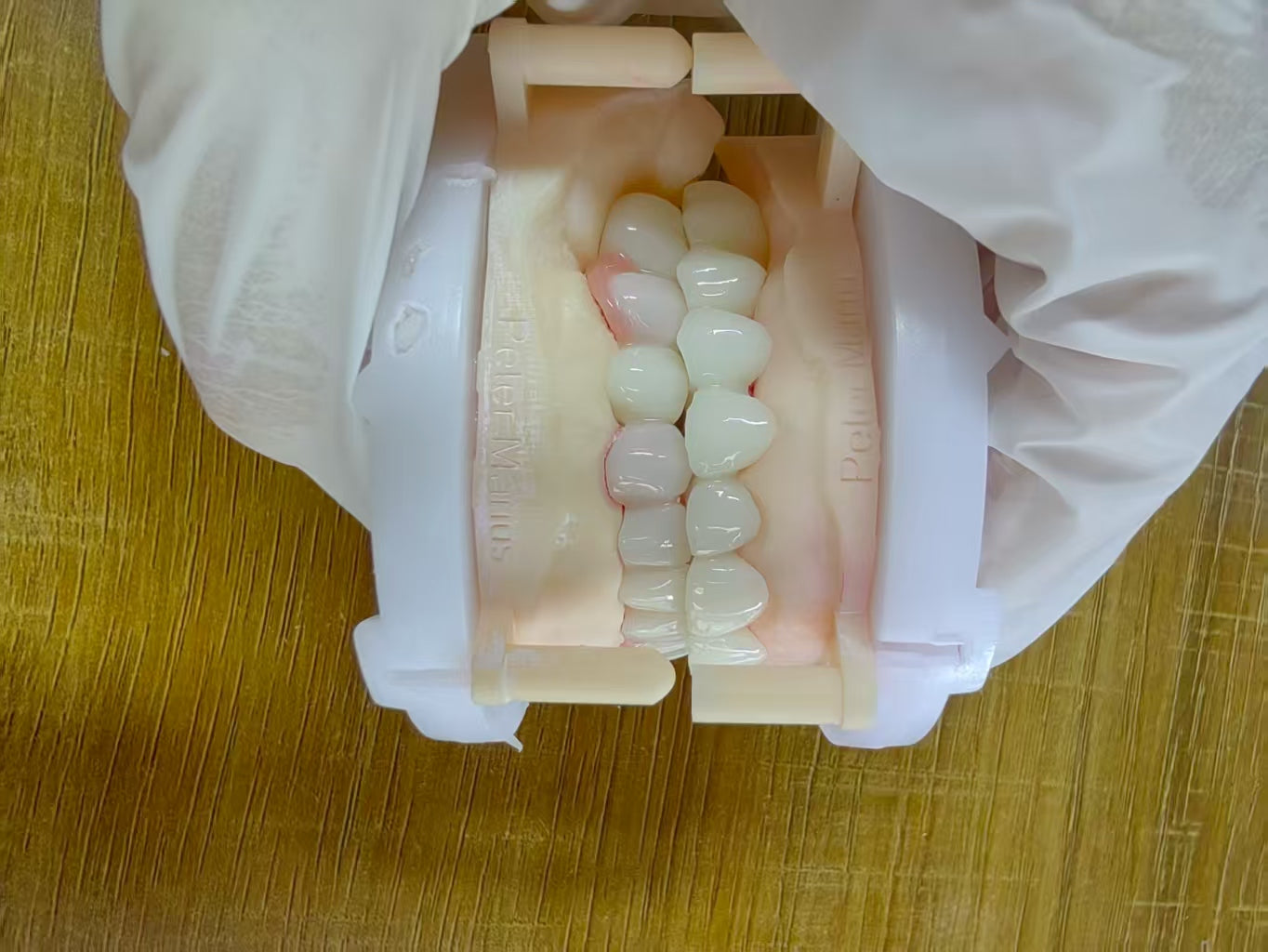 PMMA Bridge After We Received The Surgical Implant Plan Leave Holes Immediate Temporary Teeth