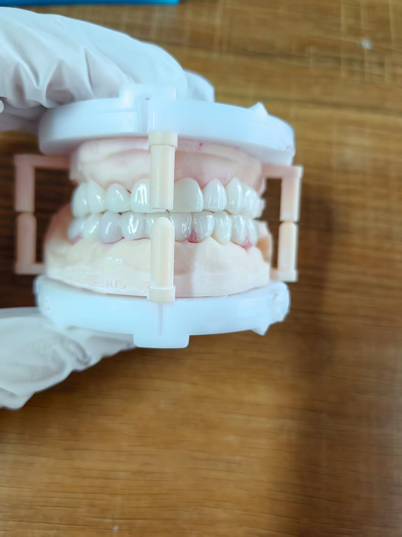 PMMA Bridge After We Received The Surgical Implant Plan Leave Holes Immediate Temporary Teeth