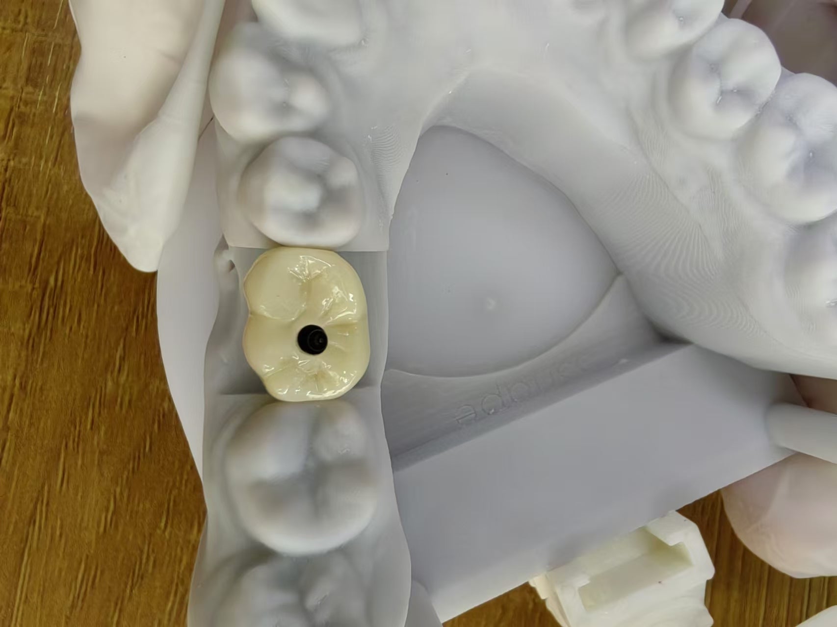 Zirconia Implant Crown Screw Retained Zirconia Dental Crown