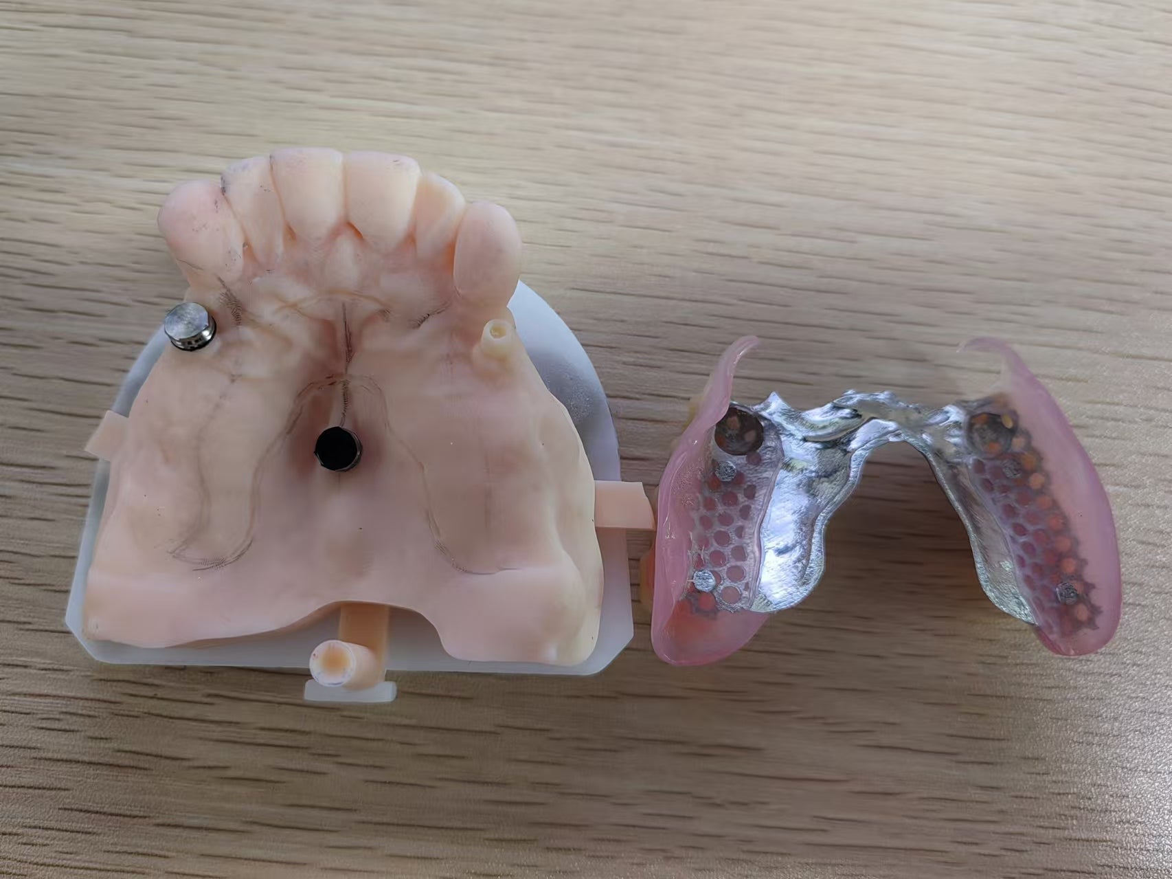 Loctor With Metal Fram Overdenture Restoration Partial Denture