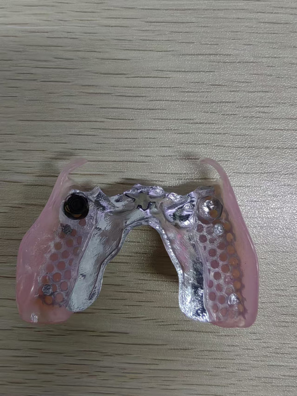 Loctor With Metal Fram Overdenture Restoration Partial Denture