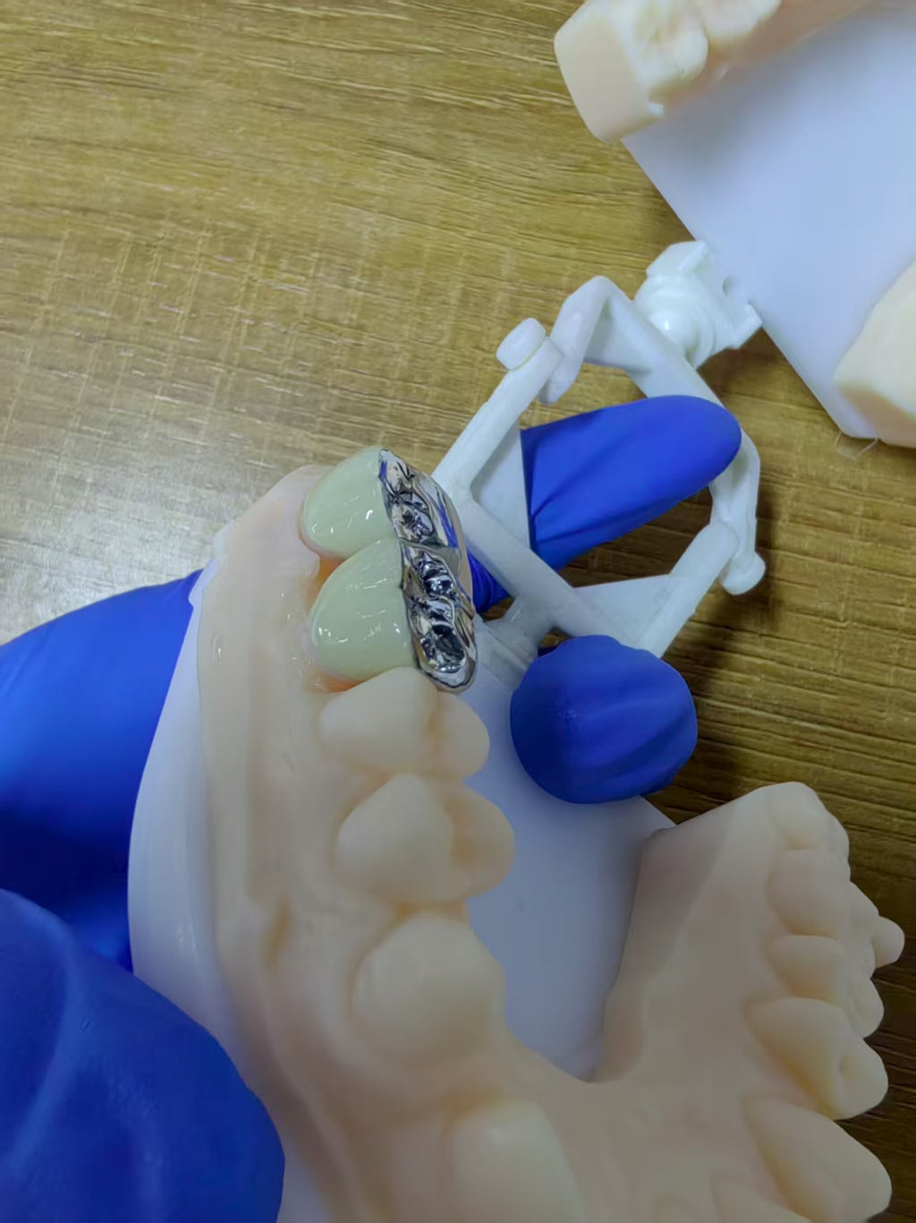 PFM Single Crowns With Metal Surface Dental Lab Cases