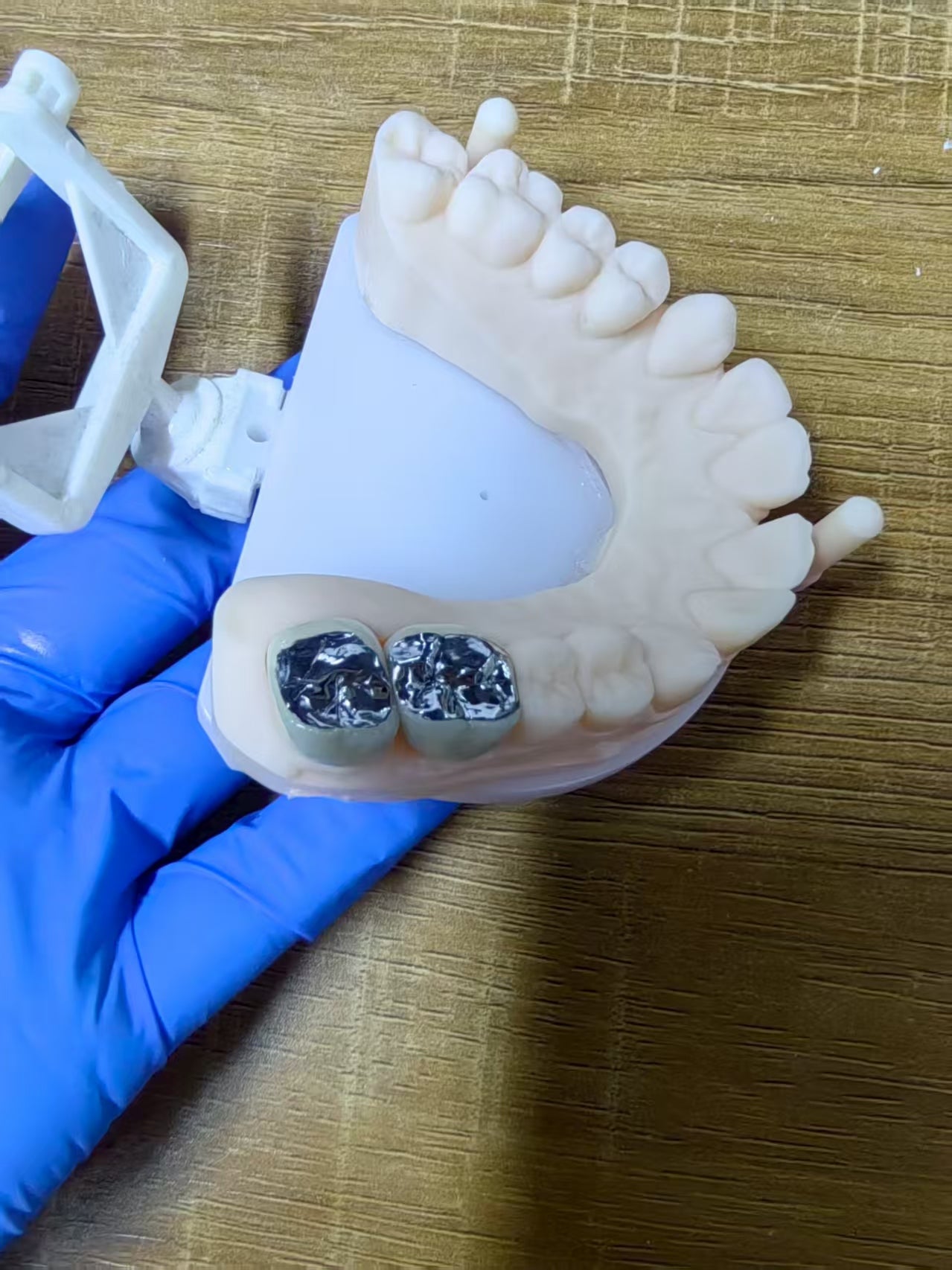 PFM Single Crowns With Metal Surface Dental Lab Cases