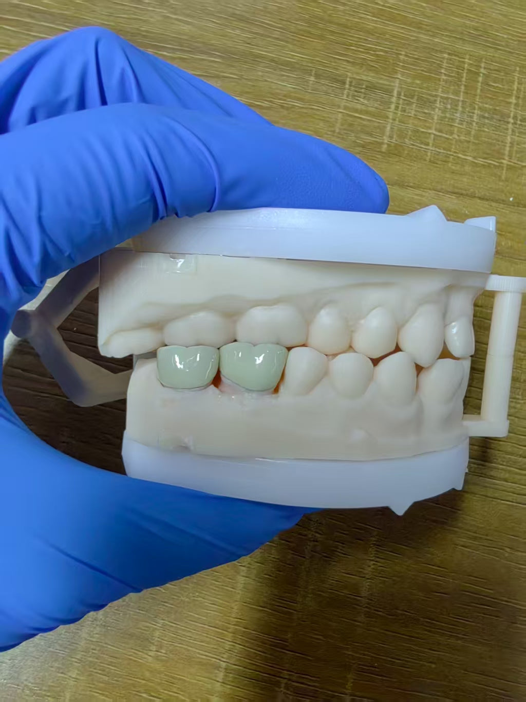 PFM Single Crowns With Metal Surface Dental Lab Cases