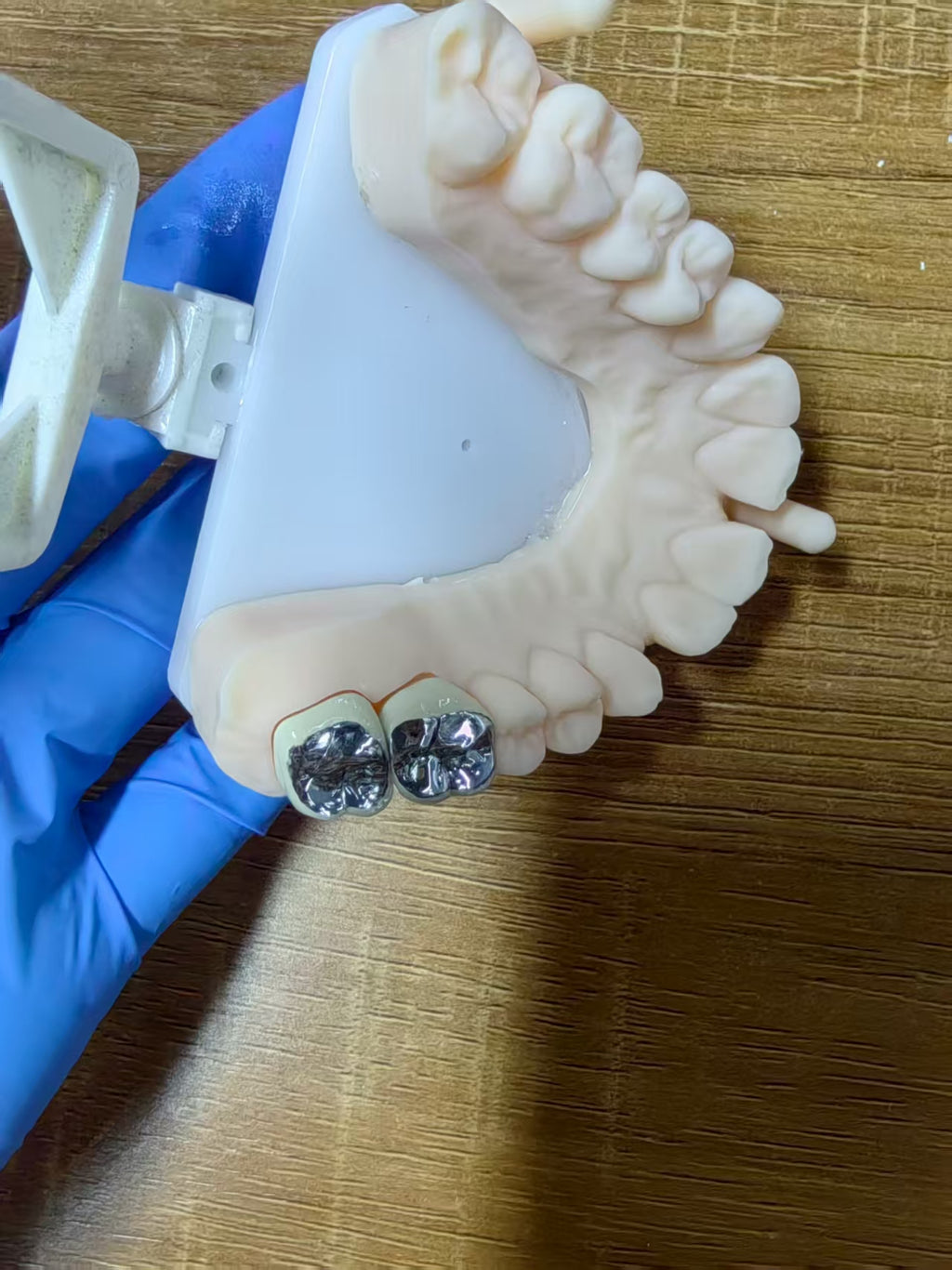 PFM Single Crowns With Metal Surface Dental Lab Cases