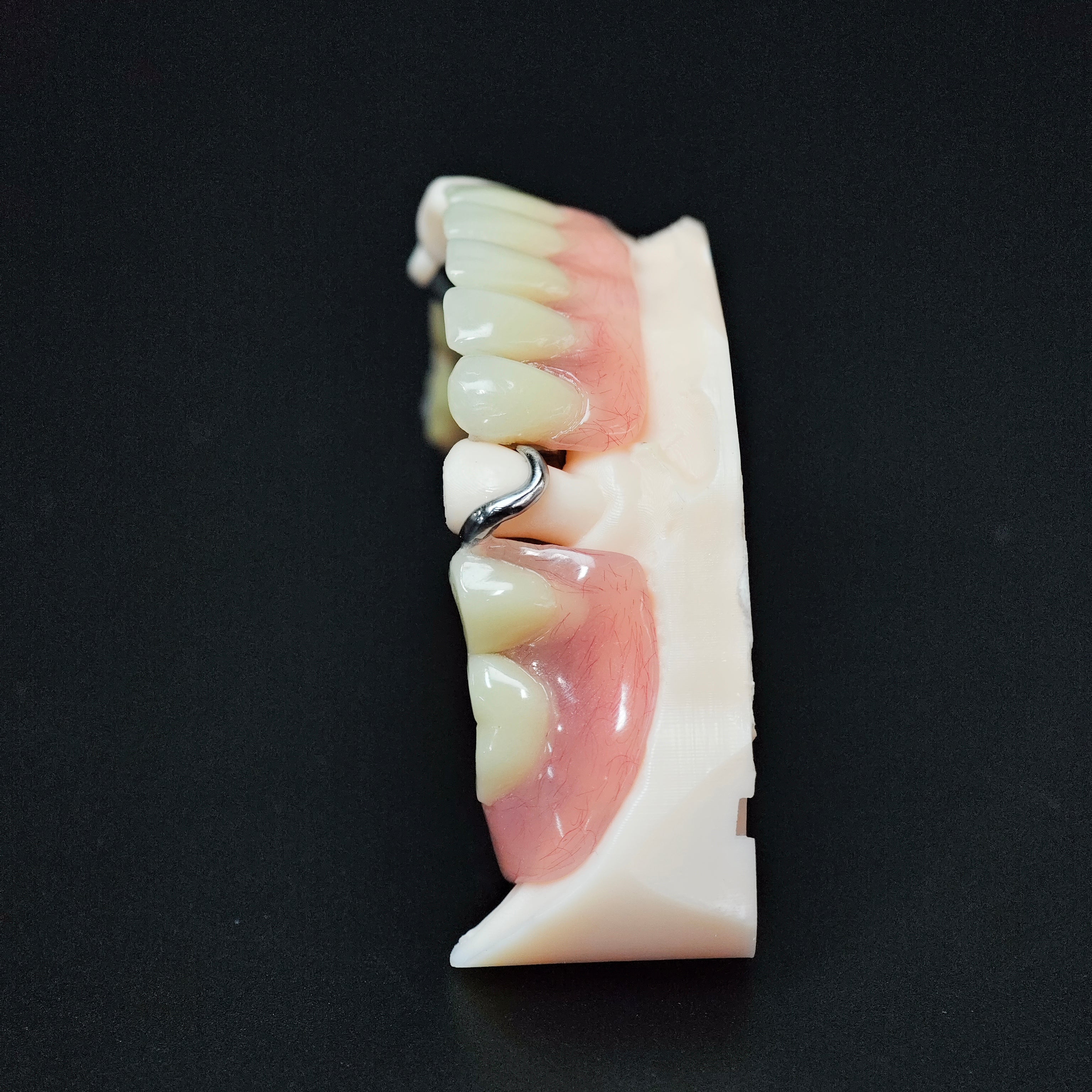 Cobalt Chrome Framework Denture Metal Framework With Acrylic Denture