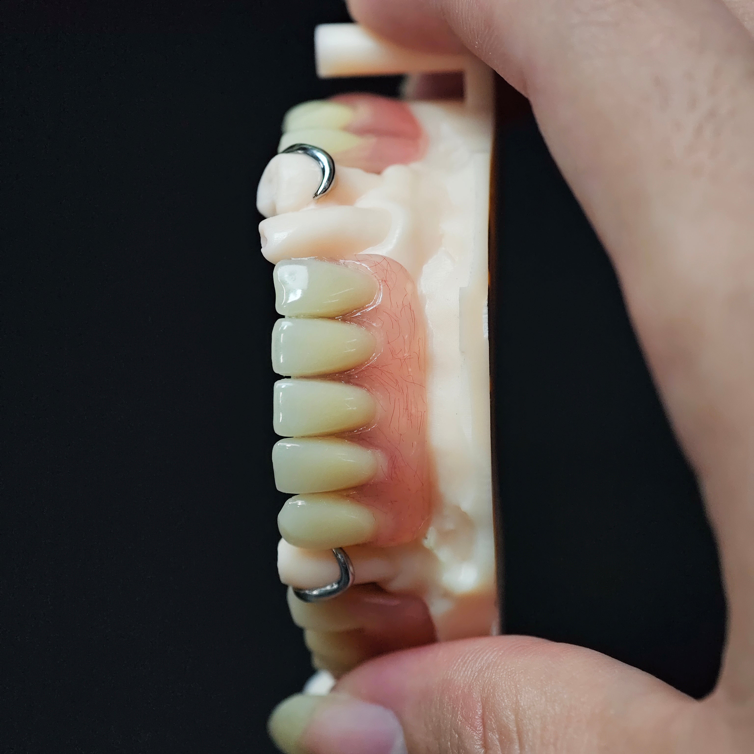 Cobalt Chrome Framework Denture Metal Framework With Acrylic Denture