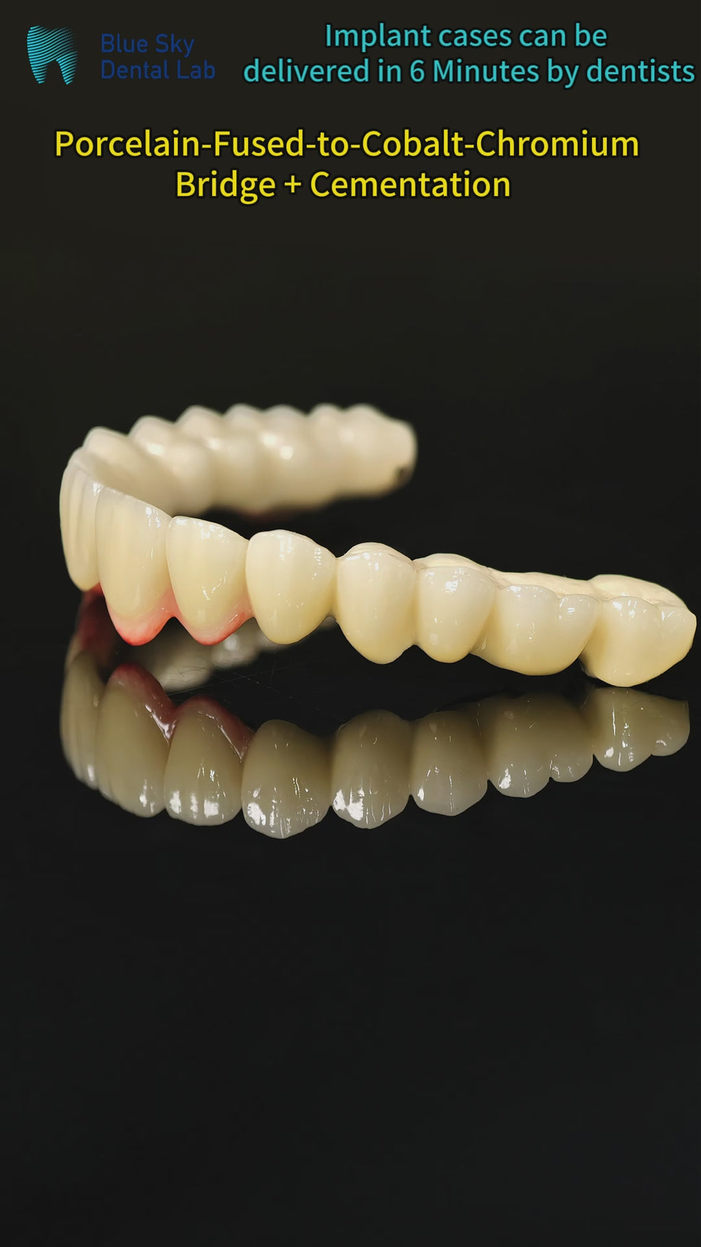 Co - Cr PFM Dental Bridge