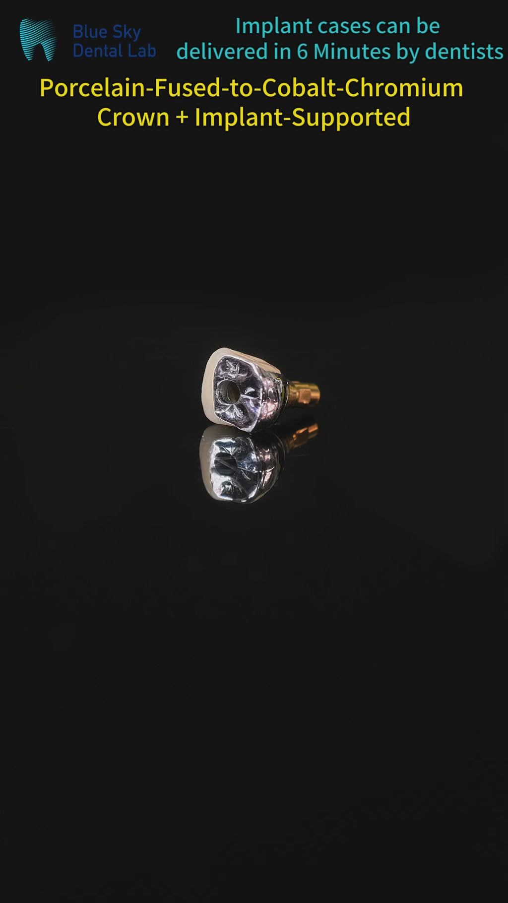 Implant-Supported PFM Single Crown With Metal