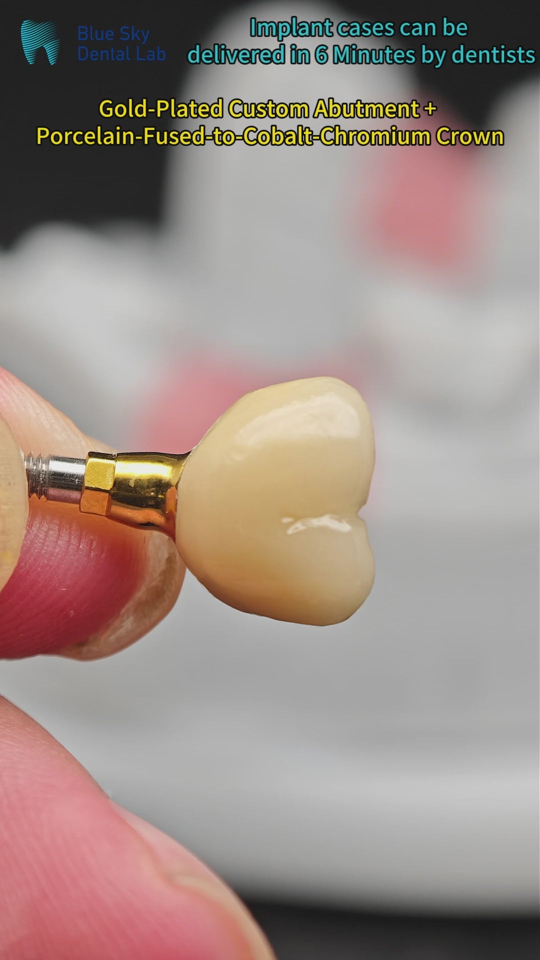 Implant-Supported PFM Single Crown With Metal