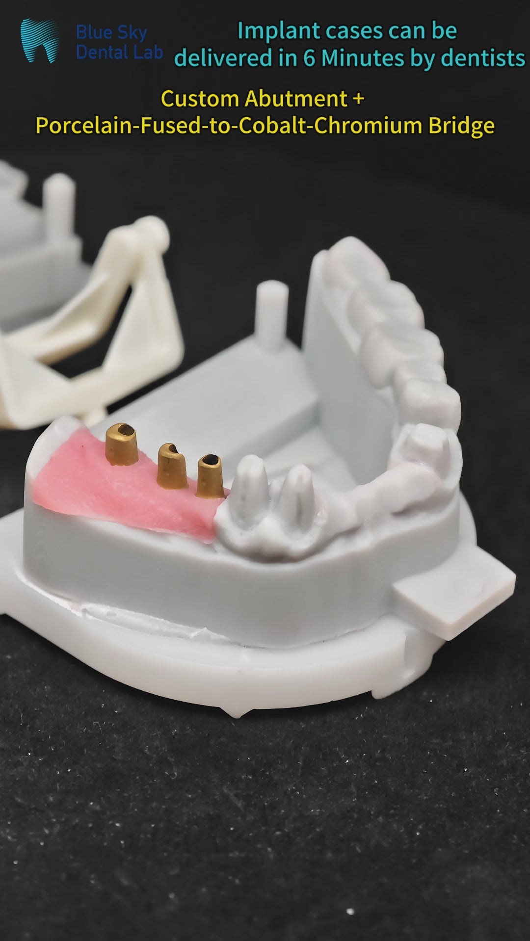 Co - Cr PFM Dental Bridge