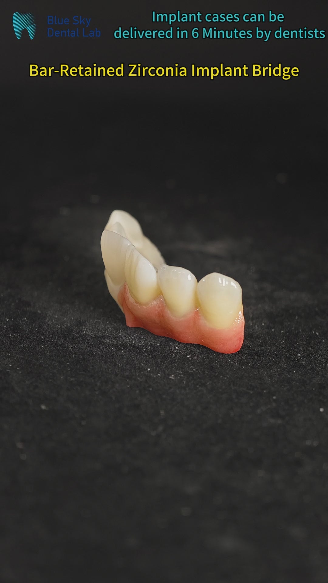 Ti-Bar Pure Titanium Metal Frame With Zirconia Bridge
