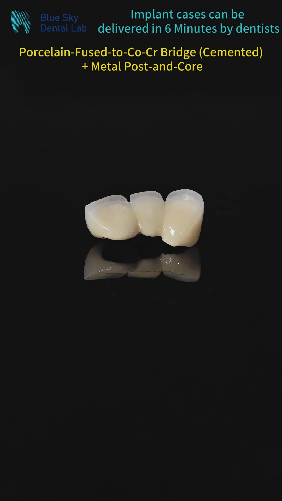 Co - Cr PFM Dental Bridge With Metal Post-And-Core