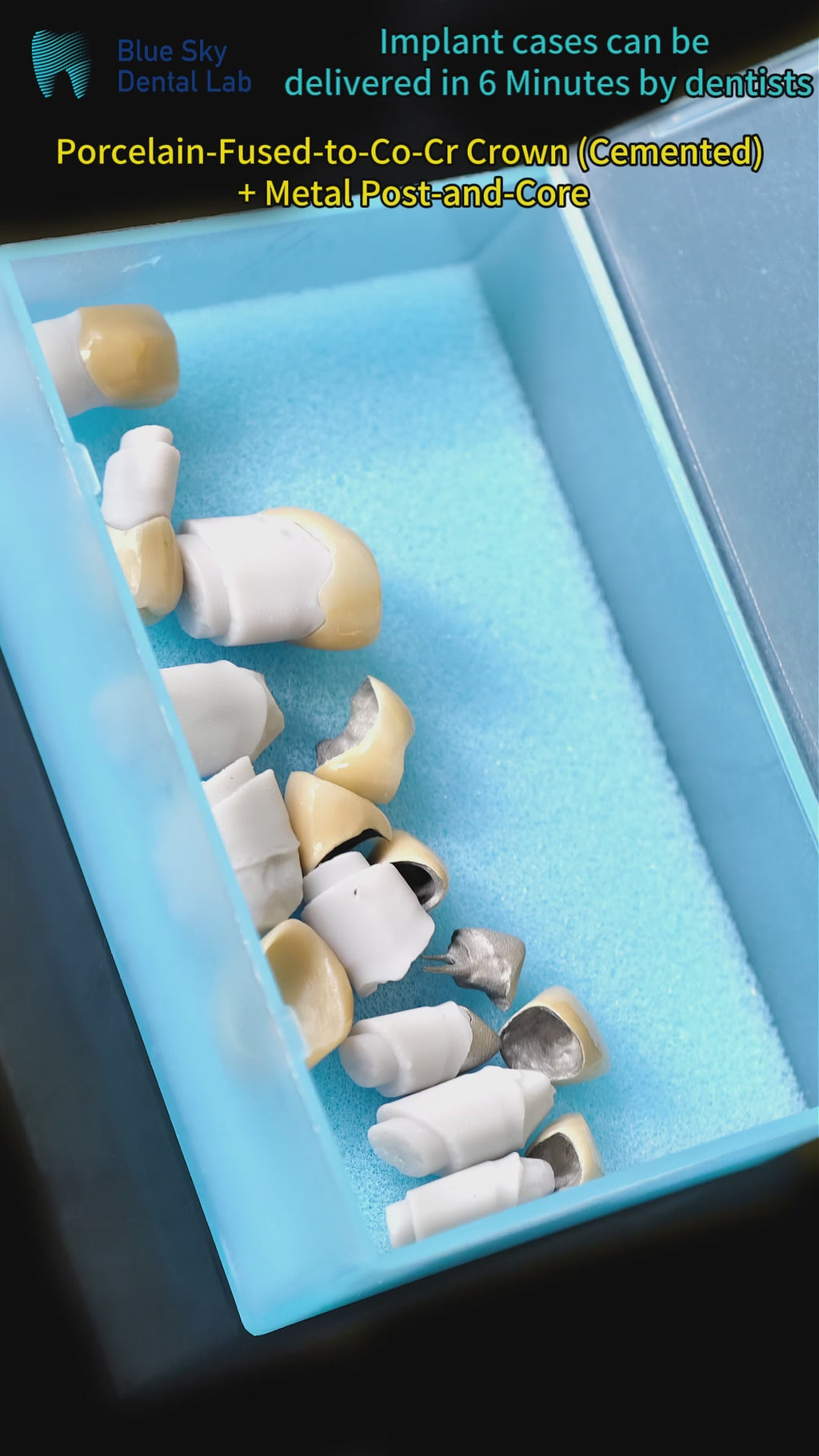 Co - Cr PFM Dental Bridge With Metal Post-And-Core