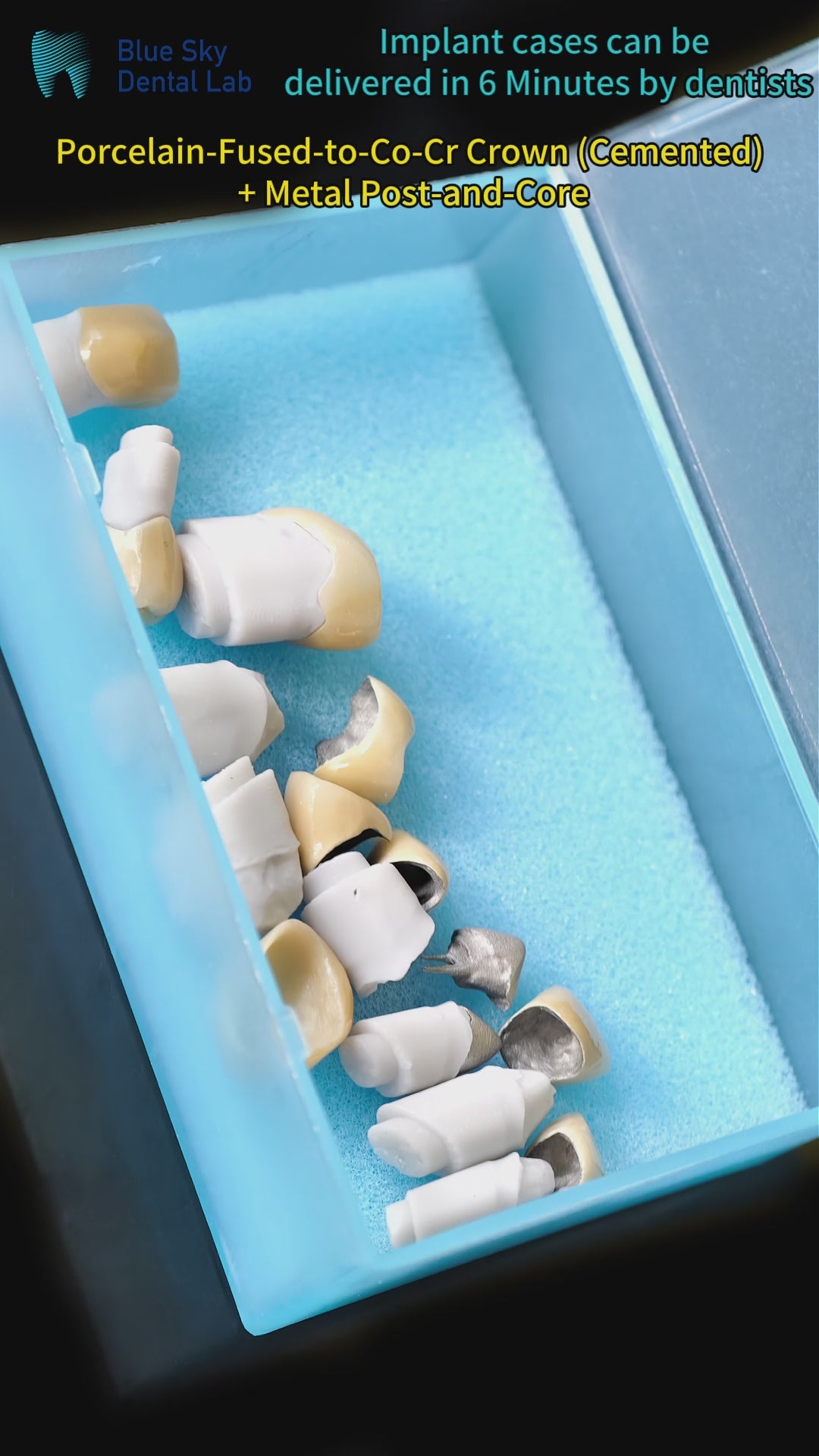 Co - Cr PFM Dental Bridge With Metal Post-And-Core