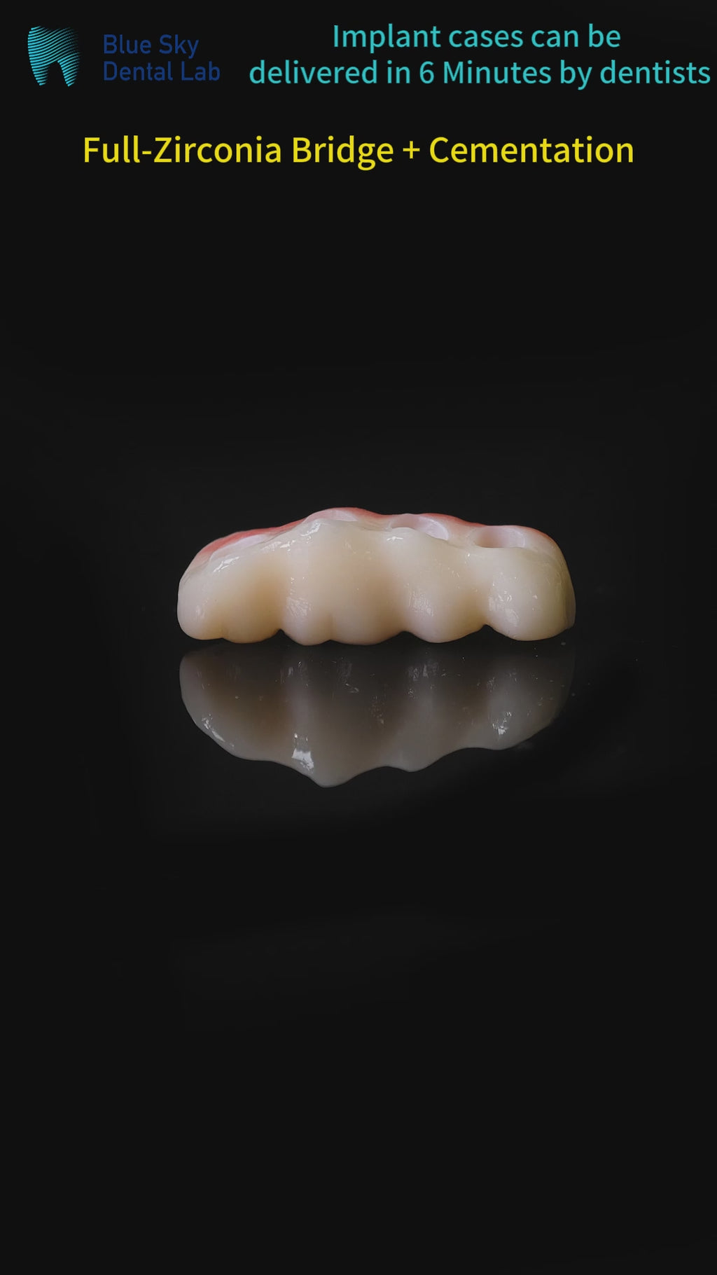 High - Strength Zirconia Bridge