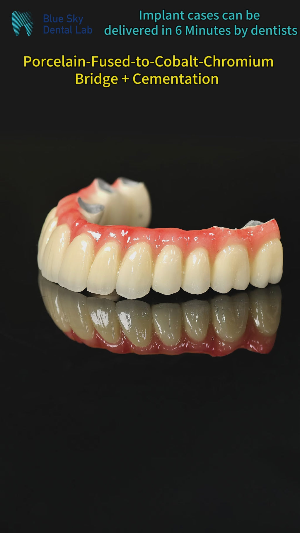 Co - Cr PFM Dental Bridge