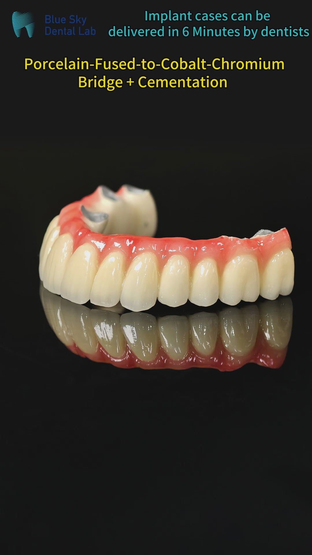 Co - Cr PFM Dental Bridge