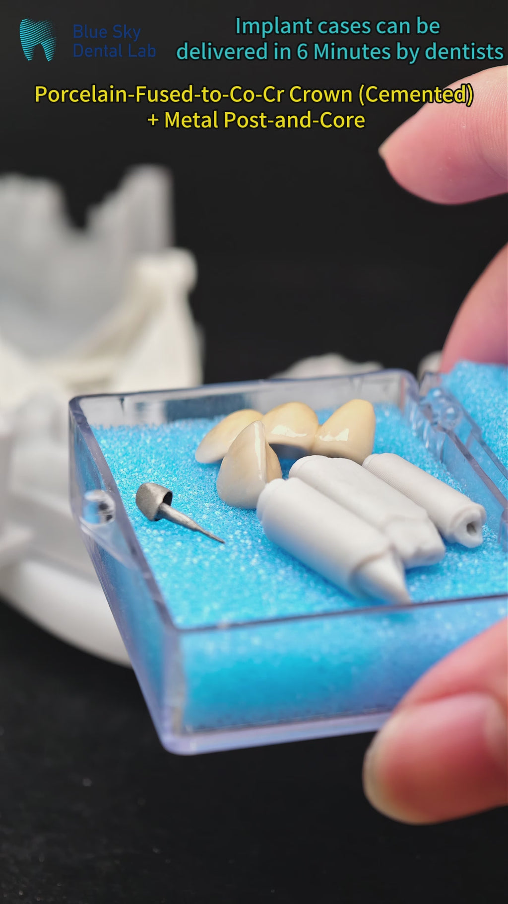 Co - Cr PFM Dental Bridge With Metal Post-And-Core