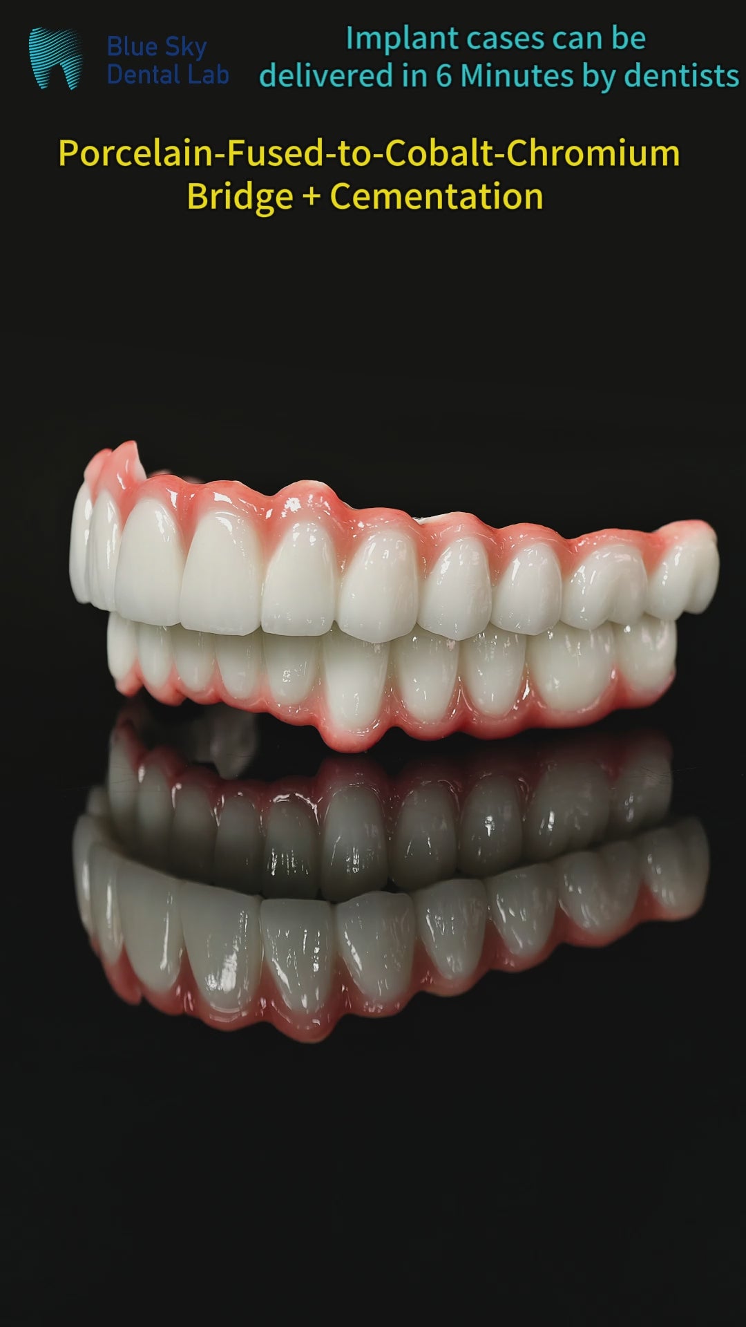 Co - Cr PFM Dental Bridge
