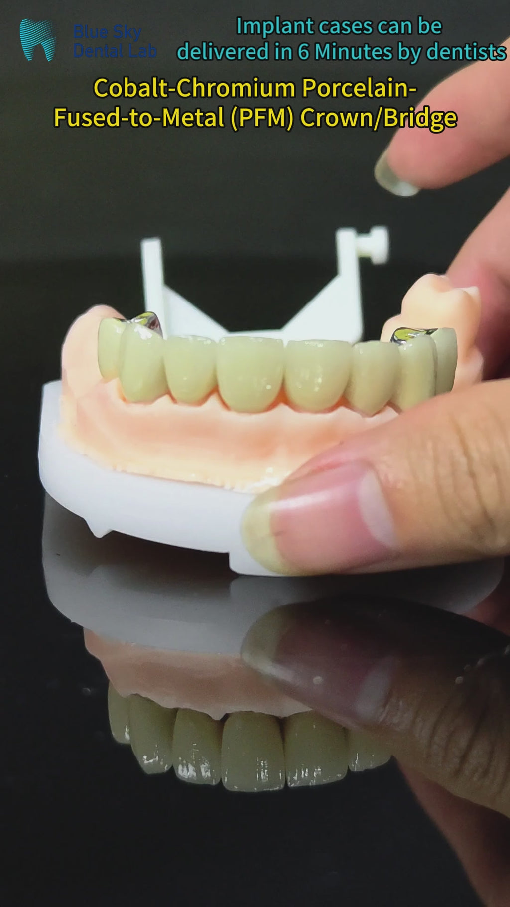 Co - Cr PFM Dental Bridge