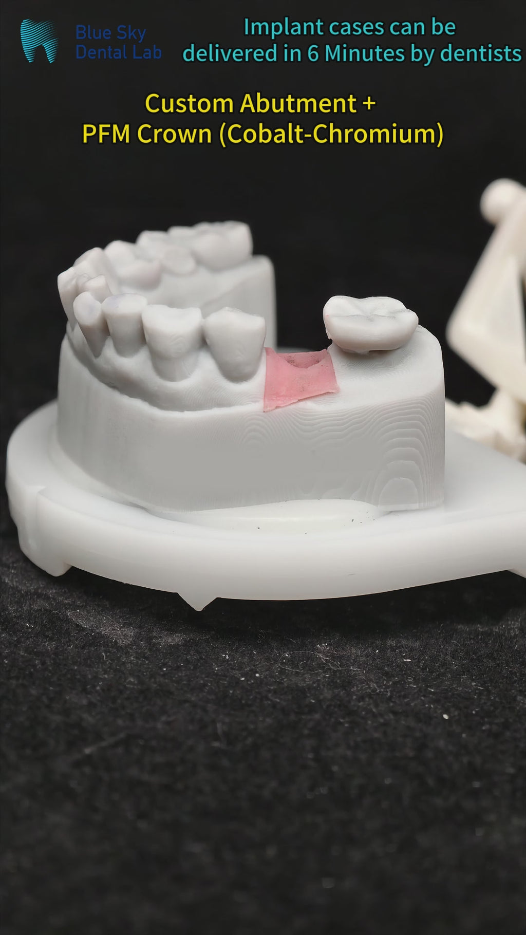 Implant-Supported PFM Single Crown