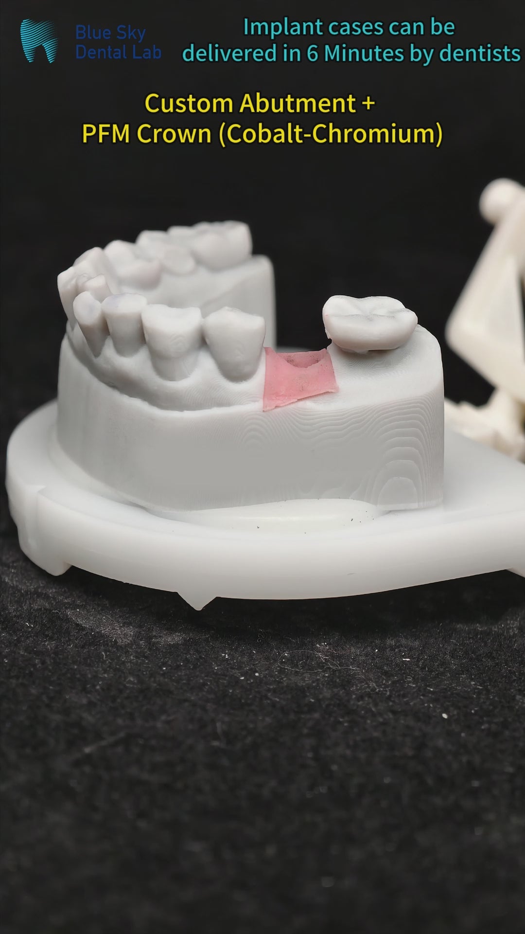 Implant-Supported PFM Single Crown