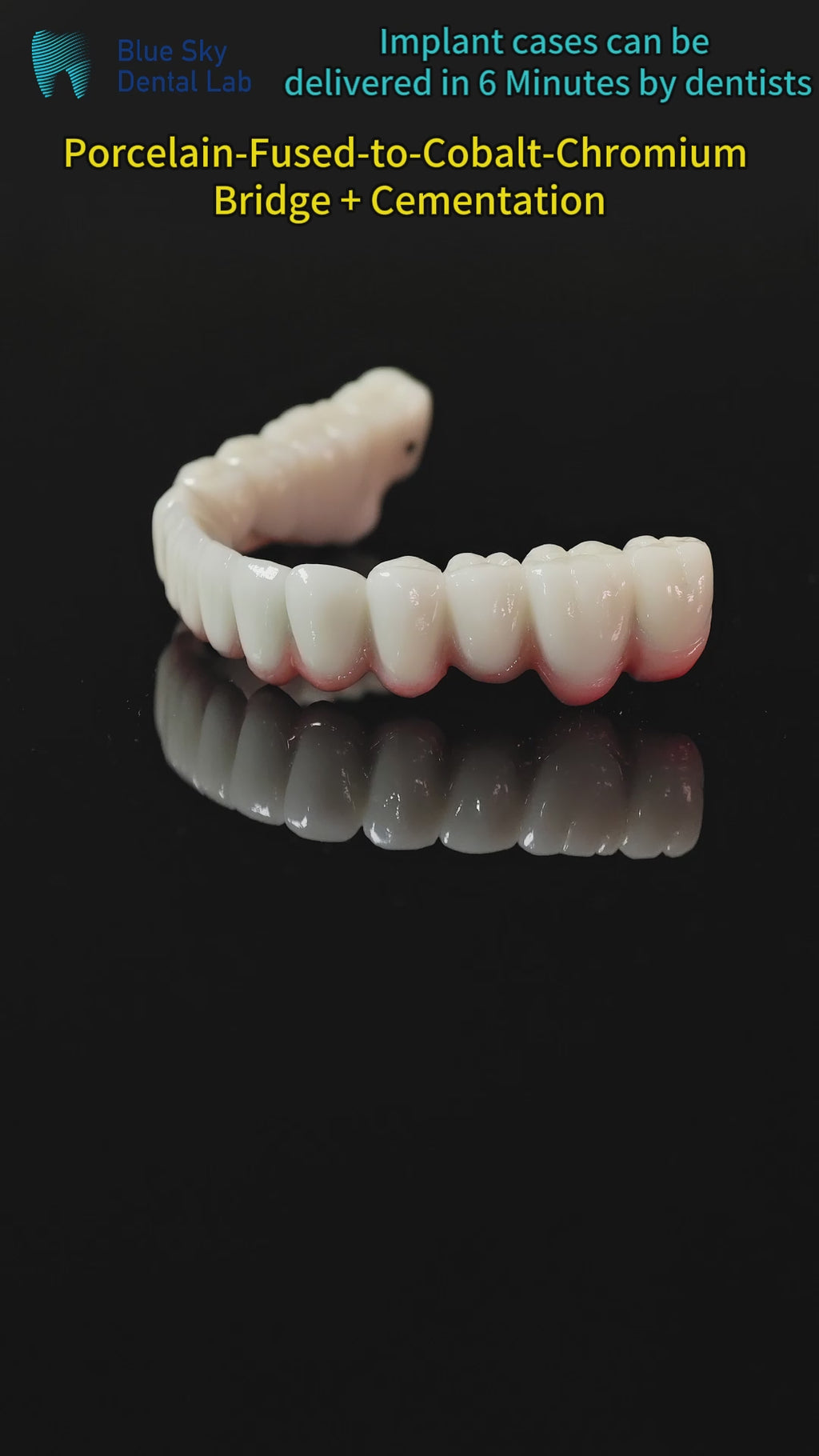 Co - Cr PFM Dental Bridge
